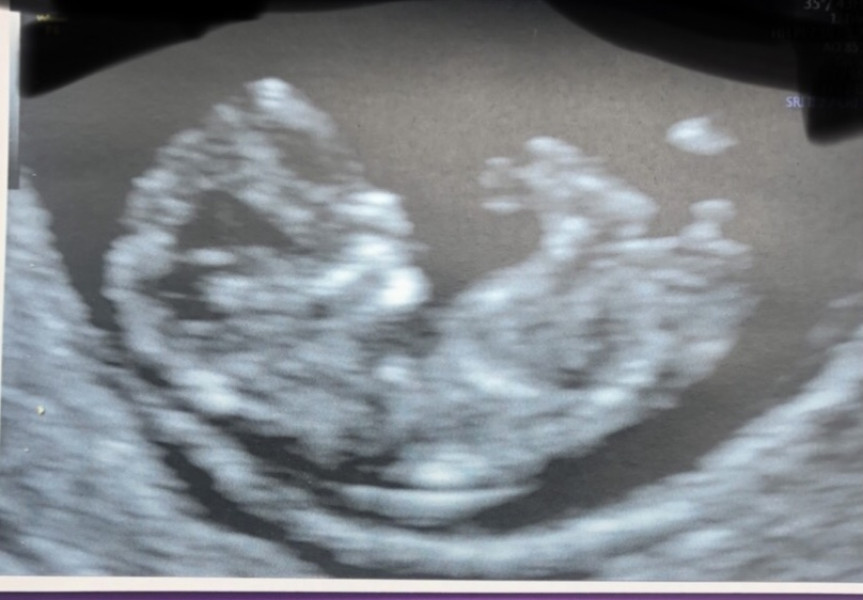 Is 10.5 weeks too early for skull predictions? 
