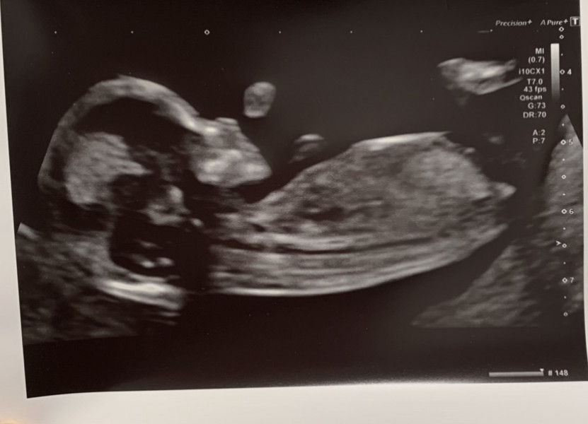BFPs following IVF to take symptoms & scans