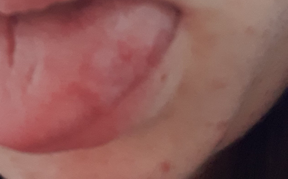 Red marks on tounge pic included