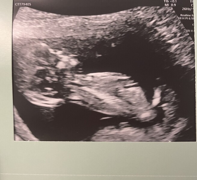 Boy or girl? Scan picture