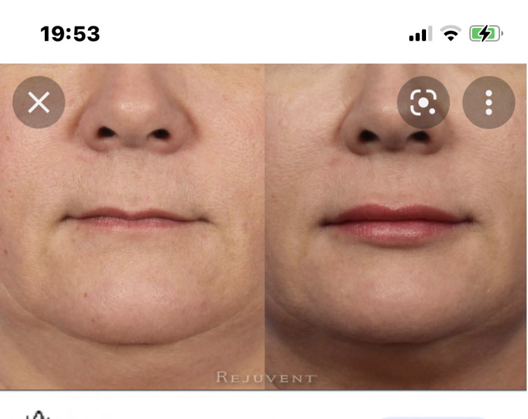 Anyone had a lip enhancement? Yes or No? Photo included :-)