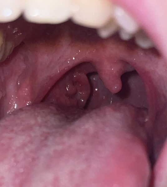 Tonsil stones