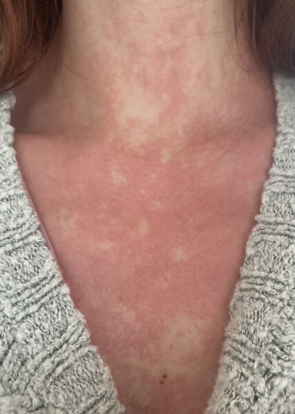 Rash every time I’m unwell!