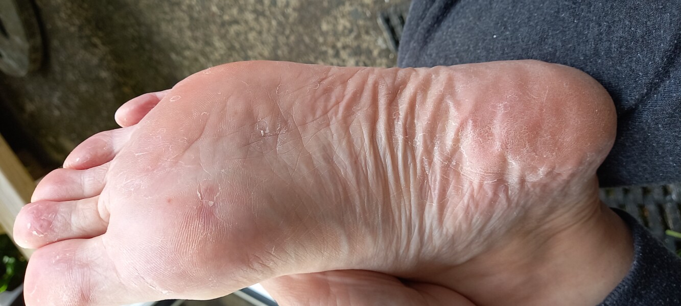 eczema or athletes foot?!