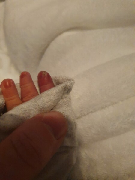 9 day old, red swollen finger and yellow pus