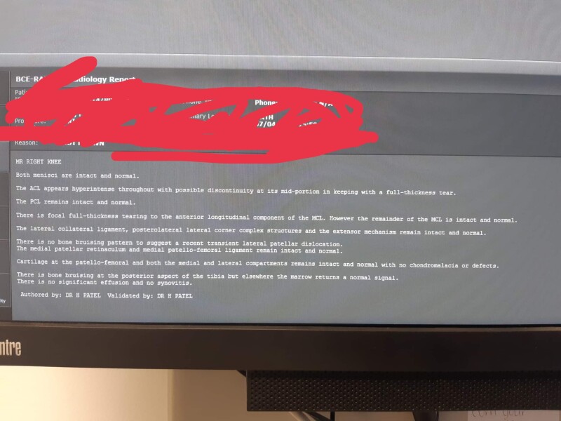 Torn ACL 2nd opinion