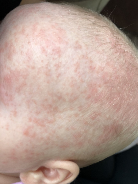 Is this baby acne and eczema