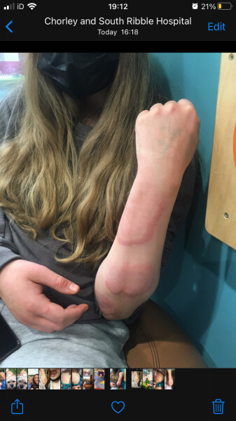 13 year old with severe hives
