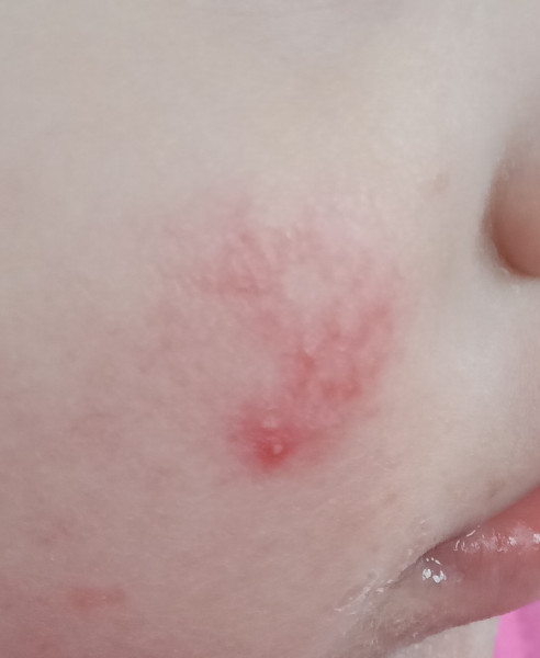 Toddler rash on cheek