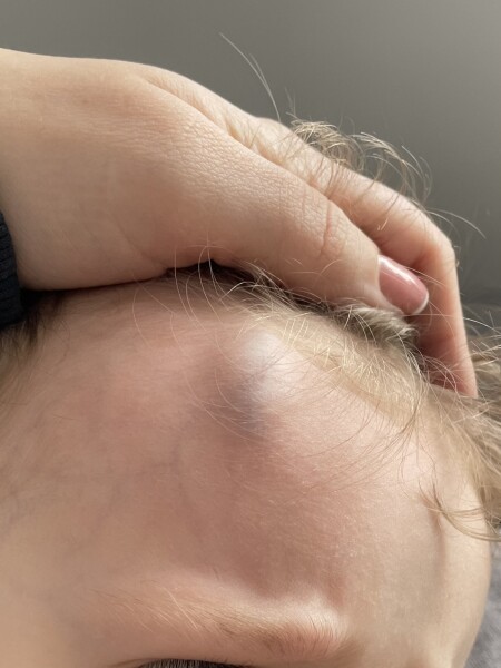 Toddler banged head!!