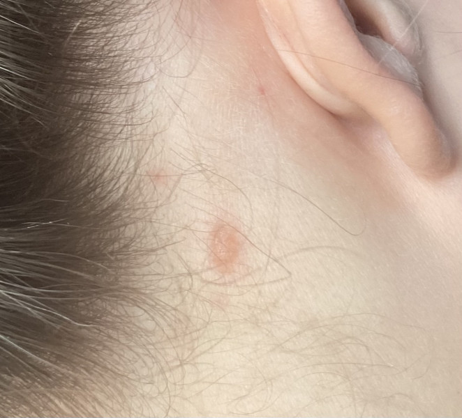 Ringworm or not?