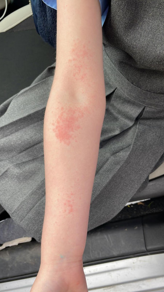 Anyone recognise this rash