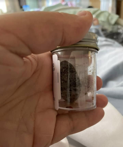 Anyone want to see my gallstones??