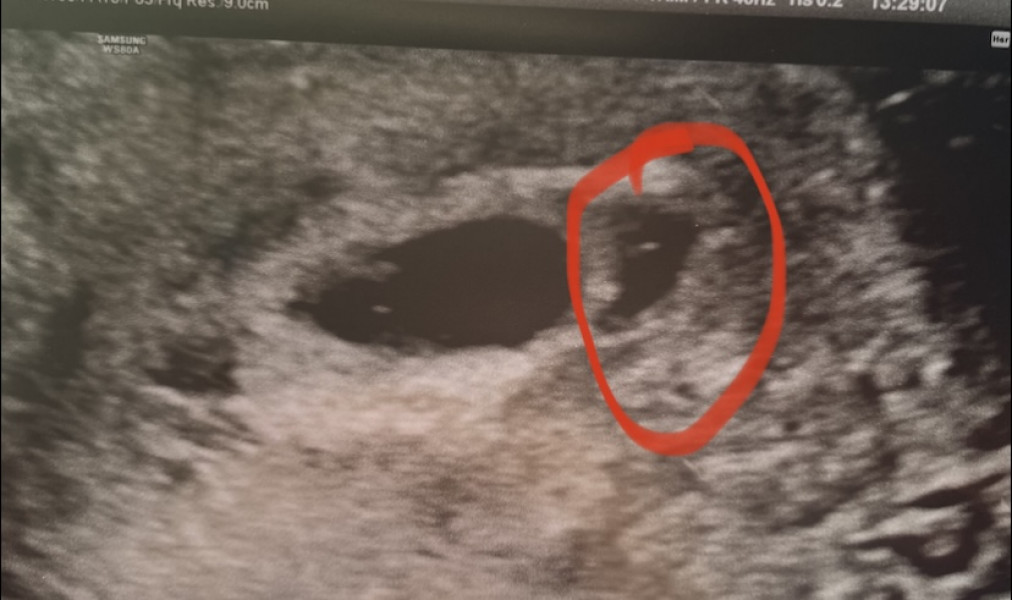 Desperate for help on ultrasound notes :(