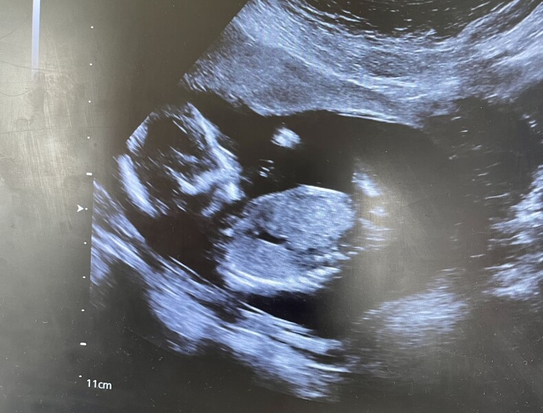 Stuck in hospital with hyperemesis, any gender guesses 15+2