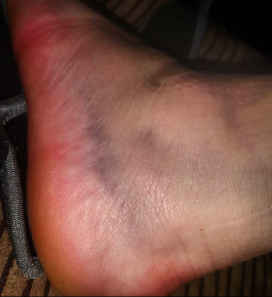 AIBU to think that this is just a sprain?