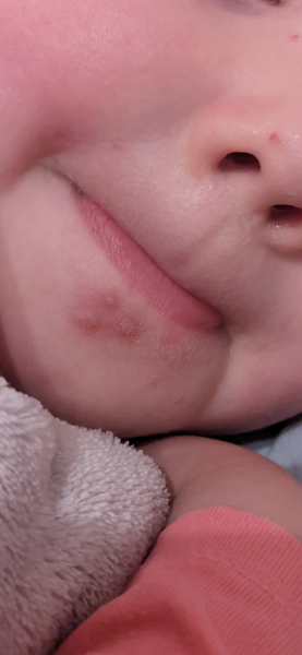 Rash on DD face