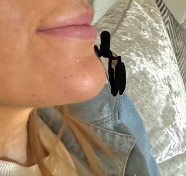 Lip filler on Monday and I’m so scared 