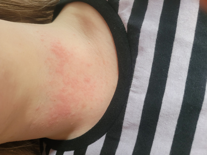 Rash - PHOTO!!