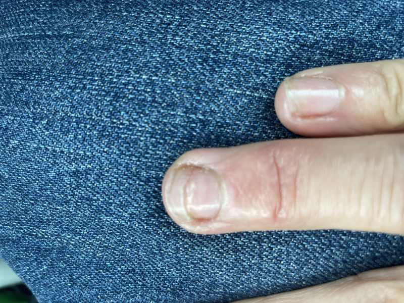 Advice needed please re damaged nail 
