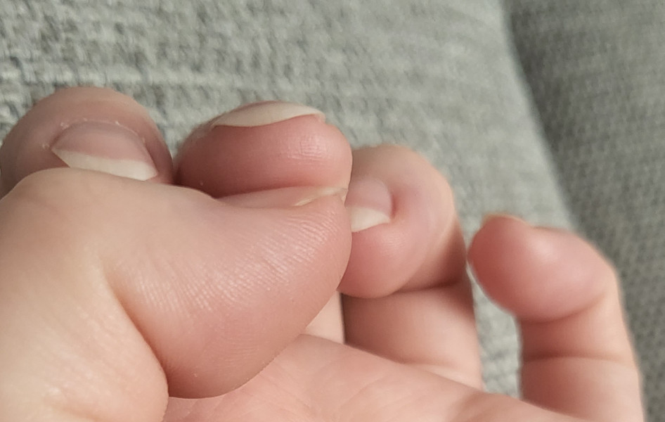Anyone else have nails like this?