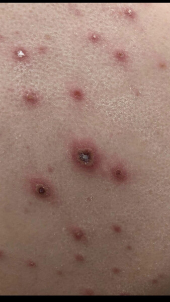 To be worried about/not want my dc to get chickenpox