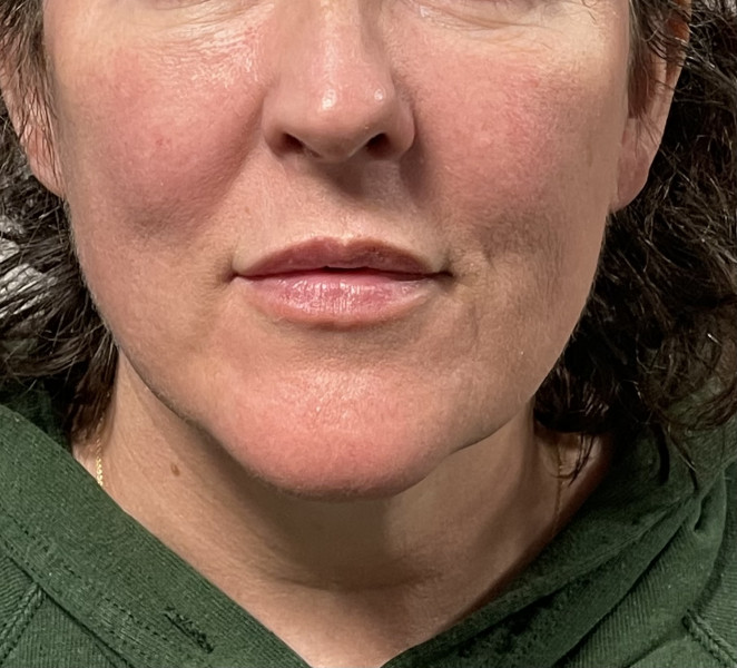 Lip filler on Monday and I’m so scared 