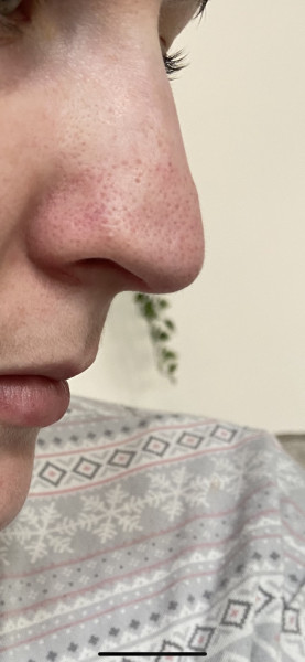How to get rid of this awful nose