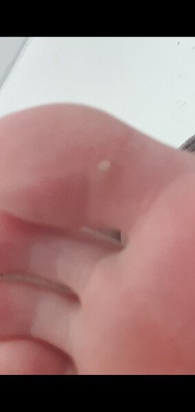 White spot on toe