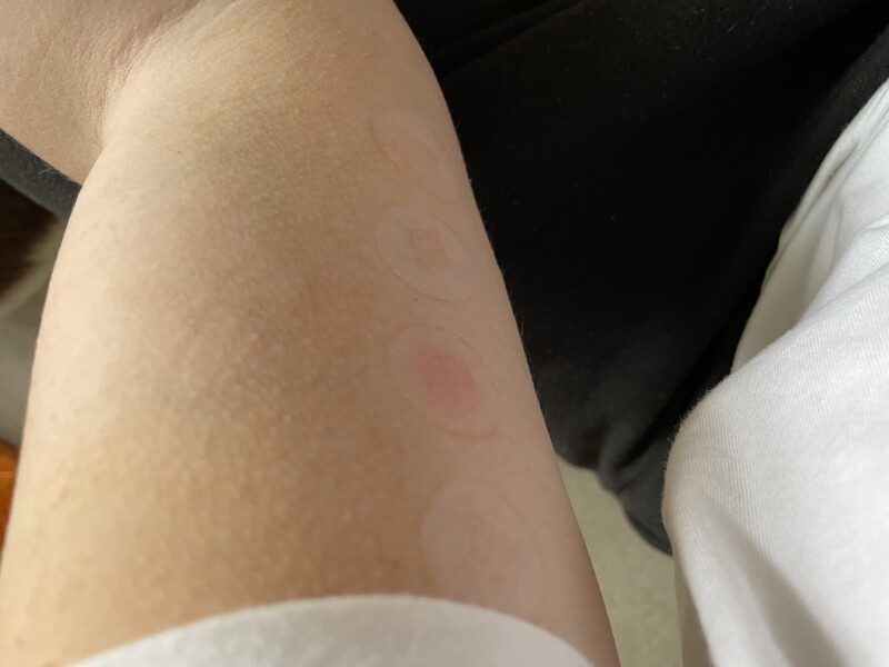 LVL - unsure if reaction to patch test?