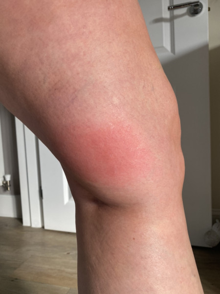 Would you see someone about these bites?