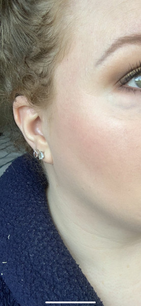 Skin peeling with ‘Retinol’