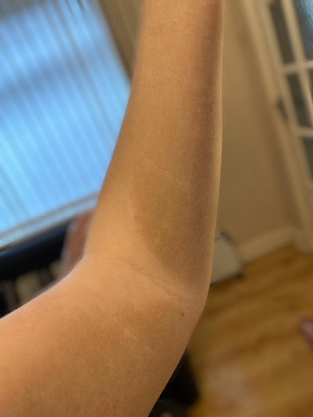 Skin discolouration