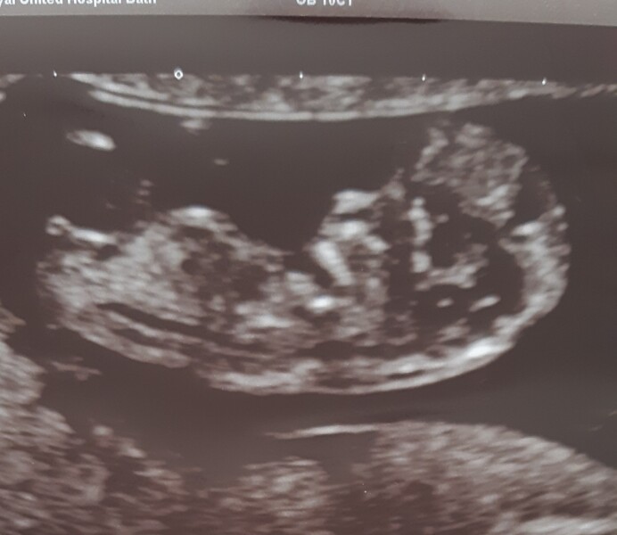 Gender prediction? Quite a clear nub I think!