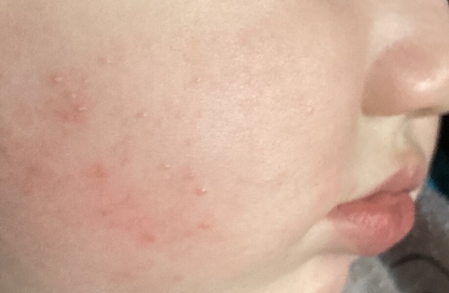 Spots on 11 month old face?