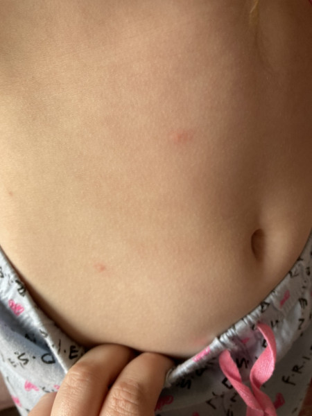 To think this isn't chicken pox?