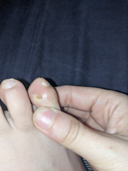 Not sure what this is on my toe?