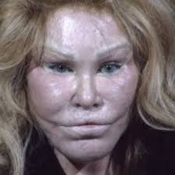 What ultimately happens to the bodies of people who have extreme quantities of fillers?
