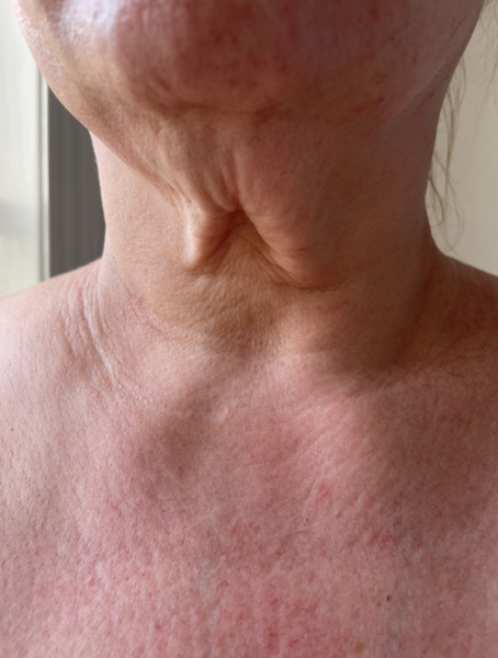 Would you have a face lift?