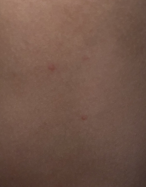 Apologises if not the right place… but are these likely to be chicken pox?