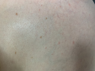 Red spots on bump- not itchy 