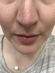 How to get rid of this awful nose