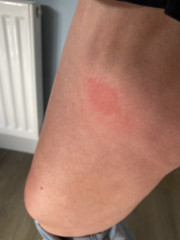 Would you see someone about these bites?