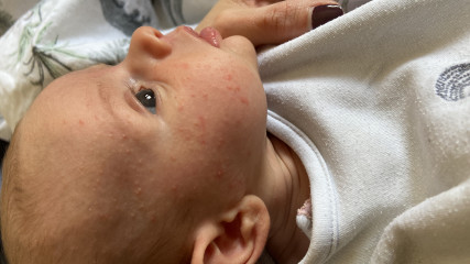 Baby acne? Mucus poo? Normal or cmpa? 