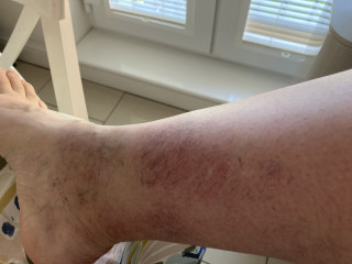 Terrible spider veins on lower legs