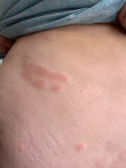 Allergic reaction?