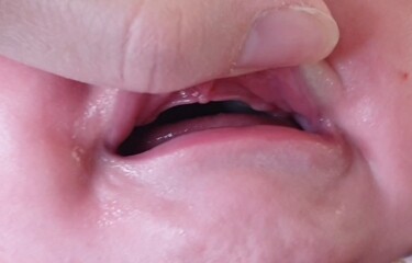 Lip tie?