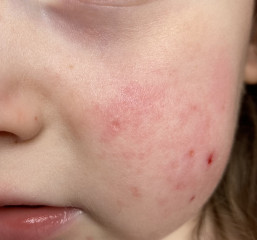 Possible allergy in 3 year old?