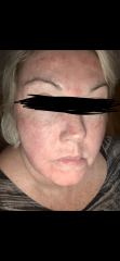 Micro needling - anyone had it done?