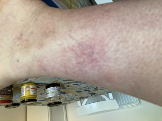 Terrible spider veins on lower legs